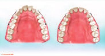 Biomechanics The conceptual approach to the biomechanics has been the development of a new category of orthodontic displacement, avoiding the binding effect.