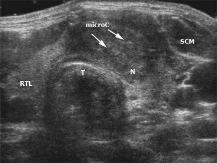 Ultrasonographic features associated with