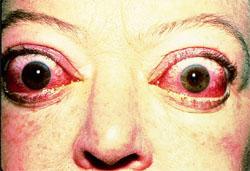 Eye signs 30% of patients with Graves show some signs of