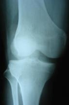 Presentation Trauma w knee pain +/-