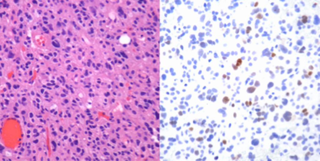 IHC, immunohistochemical; AA, anaplastic astrocytoma; H&E, hematoxylin and eosin. A B Figure 5 p53 IHC staining of an AA at 40.