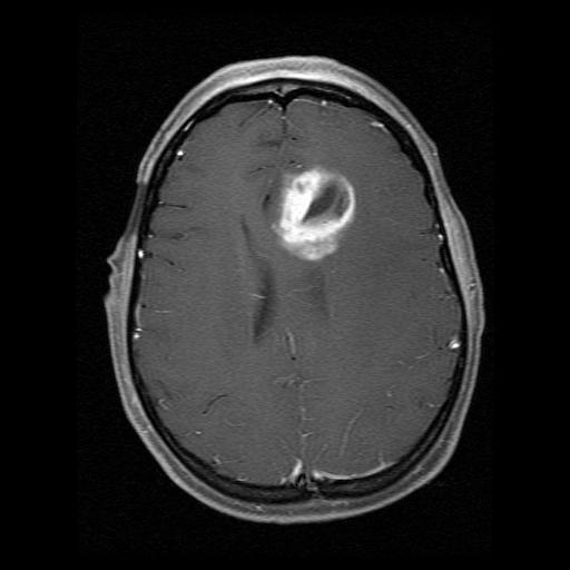Glioma Therapy esectable Unresectable Sx Bx D x st line TMZ/T TMZ st ecurrence Treatment options?