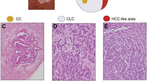 Clinicopathological study on cholangiolocellular carcinoma suggesting hepatic progenitor cell origin.