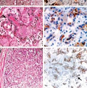 Pathology of peripheral intrahepatic cholangiocarcinoma with reference to tumorigenesis Relation to other tumours: 4.