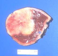 Intrahepatic cholangiocarcinoma encounters with the pathologist: 1.