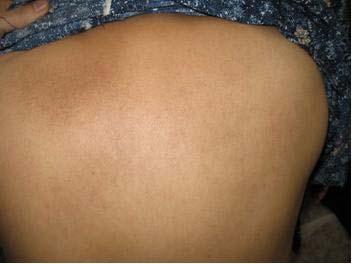 Diffuse pigmentation of back and arms configuration, the diffuse uniform pattern is more common (Figures 3-5).