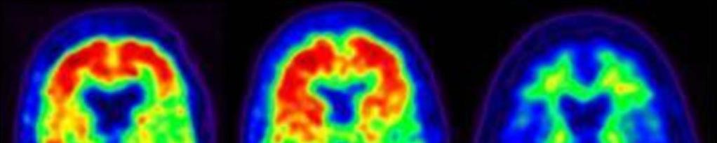 Biomarkers: Amyloid PET Alzheimer dementia Normal cognition Normal