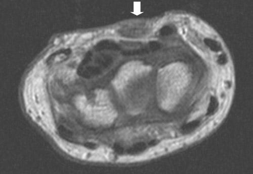 An additionally performed MRI examination showed hypertrophy of the palmaris longus muscle and compression of the outer side of the carpal tunnel (Fig. 4).