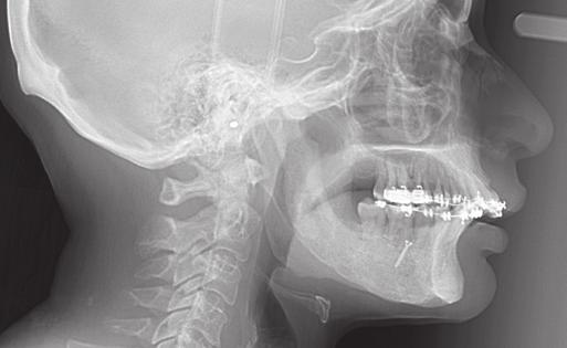 BSSO IN A RECONSTRUCTED BONE GRAFT Postoperative follow-up showed a pre-existing Class II malocclusion with traumatic gingival recession in the maxillary incisors and generalized
