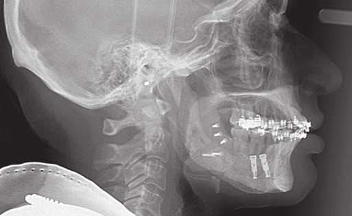 BSSO IN A RECONSTRUCTED BONE GRAFT After complete mobilisation of the proximal and distal parts, the mandible was placed into the new intermaxillary relationship using a wafer and intermaxillary wire