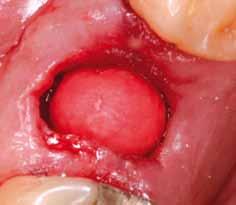 Due to the spongy conus structure, application of collacone to the wound is easily controlled.