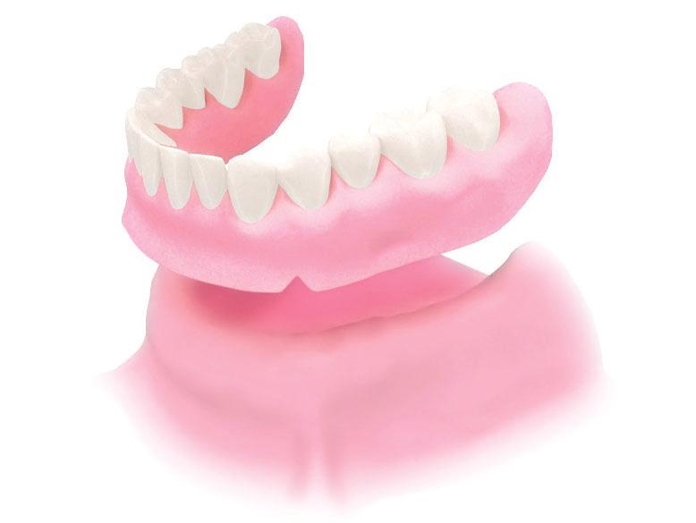 Implant vs Bridge vs Denture Implant Bridge Denture Procedure Planting inside the of missing site Shaving down both adjacent teeth and