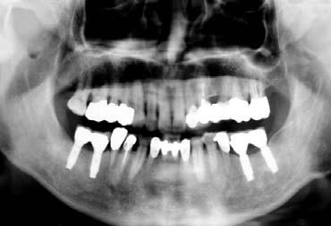 Radiograph after the