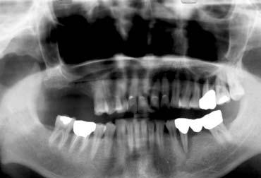 after the treatment Radiograph