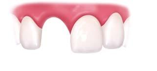 Removal of teeth Loss of all teeth Method of surgery Damage to teeth Strength of