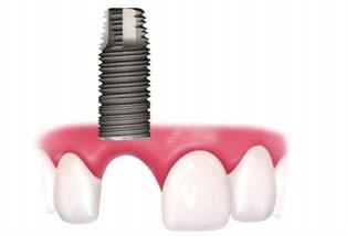 tooth inserted into the bone No damage to adjacent teeth Jawbone kept healthy;