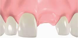 Cementation of prosthesis Teeth on both sides cut; three teeth are made into one,
