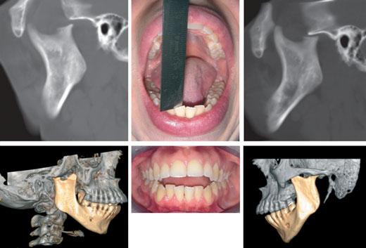 ORTHODONTICS AND TEMPOROMANDIBULAR DISORDERS 423 Fig. 5. Osteochondroma right TMJ. by arthritis persisting for at least 6 weeks, starting before the sixteenth birthday.