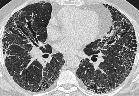 SAME RADIOLOGICAL APPEARANCE DIFFERENT DISEASE?