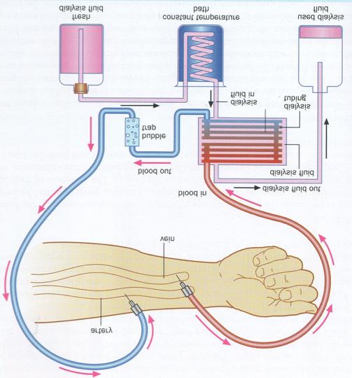 Dialysis Kidneys are not able to do their work by themselves