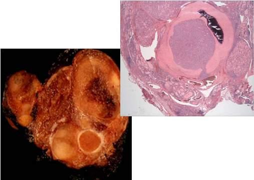 Thyroid Pathology Multiple adenomatous nodules (MAN)
