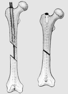 Slika 6: Skraćenje femura u sredini dijafize i osteosinteza medularnim čavlom.