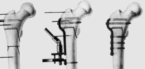 Paediatr Croat; 44 (Supl 1): 176-81 Slika 7: Skraćenje femura u proksimalnom dijelu i osteosinteza