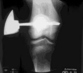 Slika 8: Intraoperacijske slike s rentgenskim pojačivačem pokazuju mikroinvazivnu