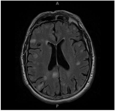 Radiosurgery > 5 lesions Whole Brain