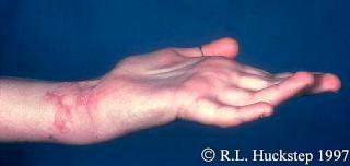 Ape hand deformity A median nerve palsy due to a wound on the palmar