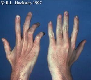 Claw hand deformity The typical appearance of an ulnar