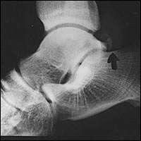 Lateral talar tubercle fractures (Sheppards fracture) Inversion or