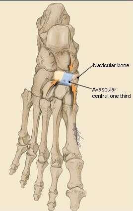 Tarsal Navicular Fracture Dorsal view of the tarsal navicular bone.