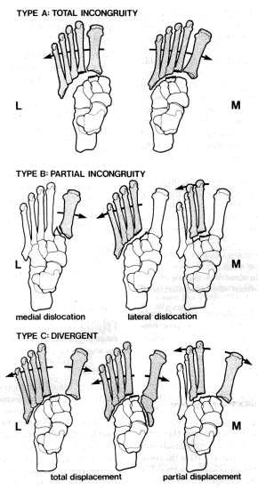 Lisfranc Classification Controversial whether or not this has prognostic significance Probably better to fix fracture