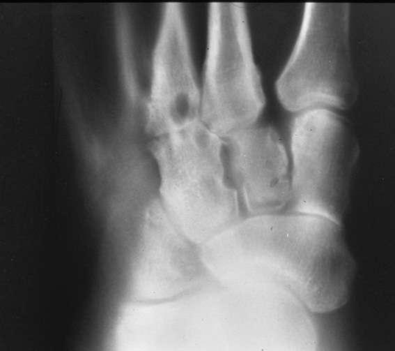 Lisfranc - Late Complications Post-traumatic arthrosis Persistent midfoot