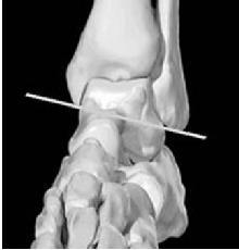 Tibiotalar Motion As ankle dorsiflexes, it externally rotates. As ankle plantarflexes, it internally rotates.