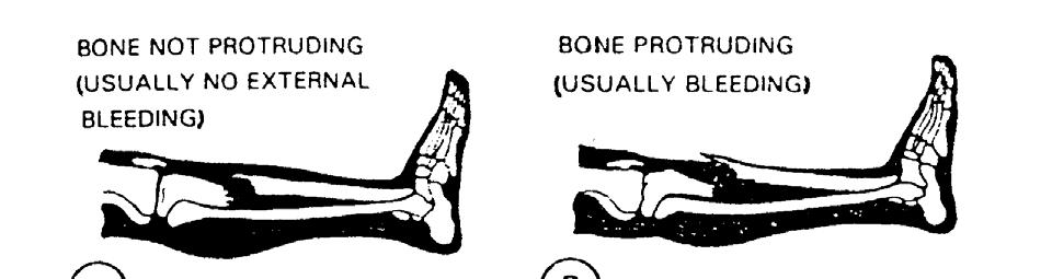 Figure 1-3. Examples of fractures. 1-6.