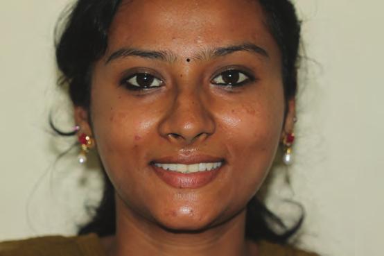 Bhuvaneswaran Patient Complaint and History A 22-year-old female patient was unhappy with her discolored upper anterior teeth (Fig 1); her greatest wish was to have a beautiful smile.