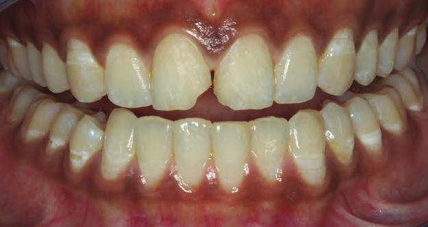 Discussion: Composite Resin It is important that the dentist understand completely the properties of the prospective restorative material to determine its suitability for a particular case and that