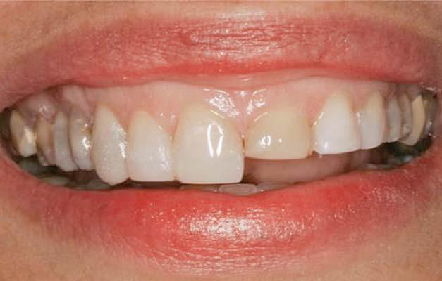 TREATMENT PLANNING AND SMILE DESIGN USING COMPOSITE RESIN Robert Marus, DDS* MARUS 18 4 MAY Recent advances in dental materials and adhesive protocols have expanded the restorative procedures