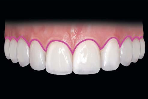 At the conceptual level, however, the procedure begins with an understanding of smile design.