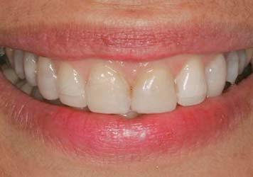 Practical Procedures & AESTHETIC DENTISTRY or with respect to the existing untreated dentition to ensure optimal aesthetics. 9 The gingival tissue generally runs parallel to the upper lip.