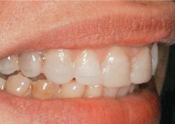 In the in vivo application of smile design, the above features are applied in accordance with the intended treatment.