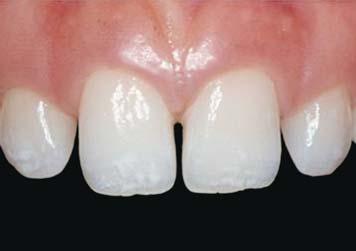 When using the technique for porcelain veneer cases, the intraoral composite mockup is performed as the first step under local anesthetic (Figures 6 and 7).