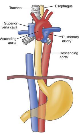 DESCENDING ANEURYSM Descending aortic aneurysm account for 45% of all thoracic aneurysms. Most are also diagnosed in their 6th and 7th decade of life.