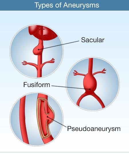 An aneurysm is a dilation of a blood vessel >50% of its normal diameter True aneurysm includes all 3 layers Fusiform aneurysm affects the entire perimeter of the vessel Saccular aneurysm