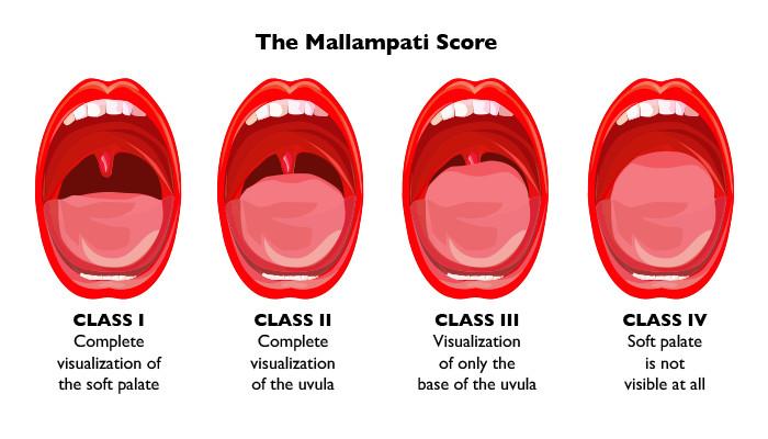 Mallampati Score This test requires patient to be sitting upright with their head
