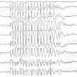 EEG Strongly predictive of epilepsy 1.5-1.