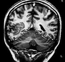 Neuroimaging Neuroimaging should be used to identify structural abnormalities that cause certain epilepsies. MRI should be the imaging investigation of choice.