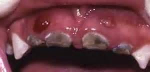 Destruction continues Then the bacteria move to the inner tooth material (pulp) that contains nerves and blood vessels. The pulp becomes swollen and irritated from the bacteria.